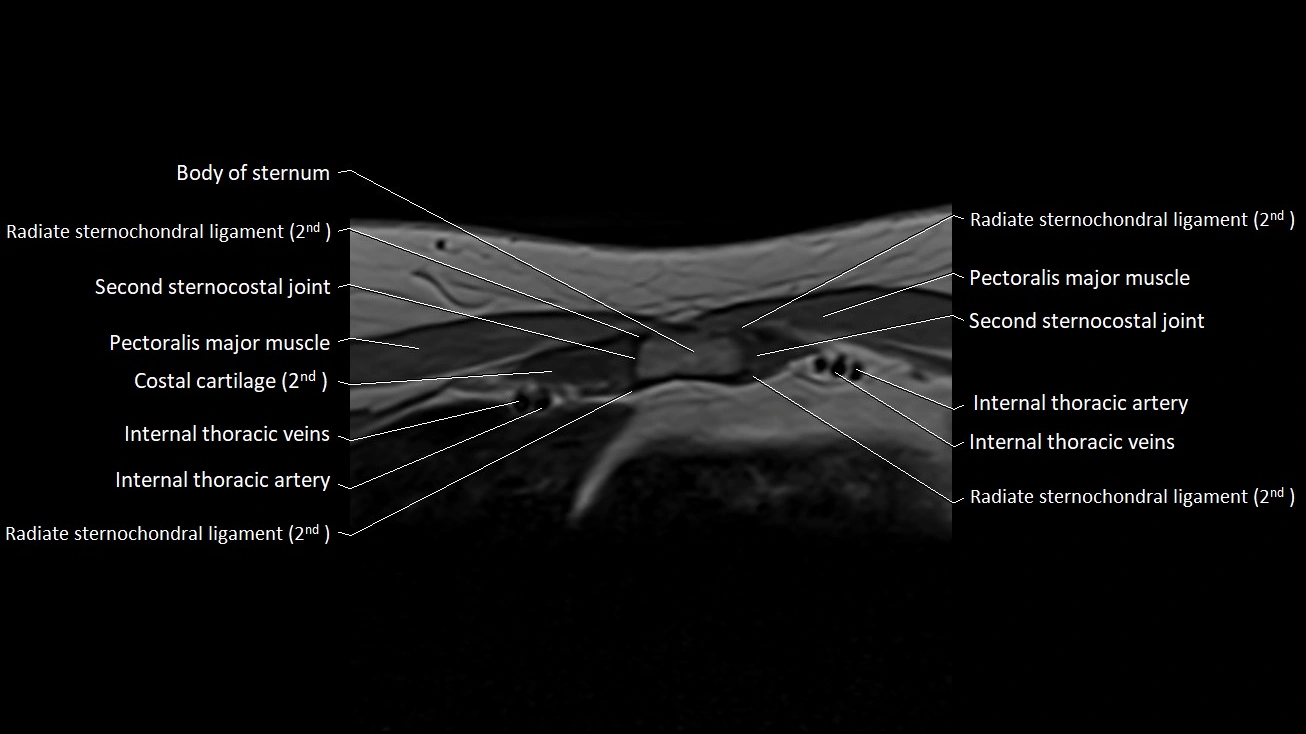 MRI sternum and sternoclavicular joint labeled axial anatomy image 14.webp